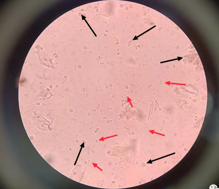 婦科感染中的極特殊情況了解下！