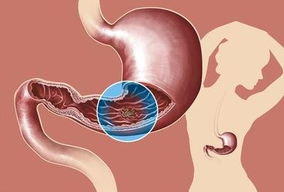 做好這些|慢性萎縮性胃炎離胃癌就會(huì)更遠(yuǎn)！